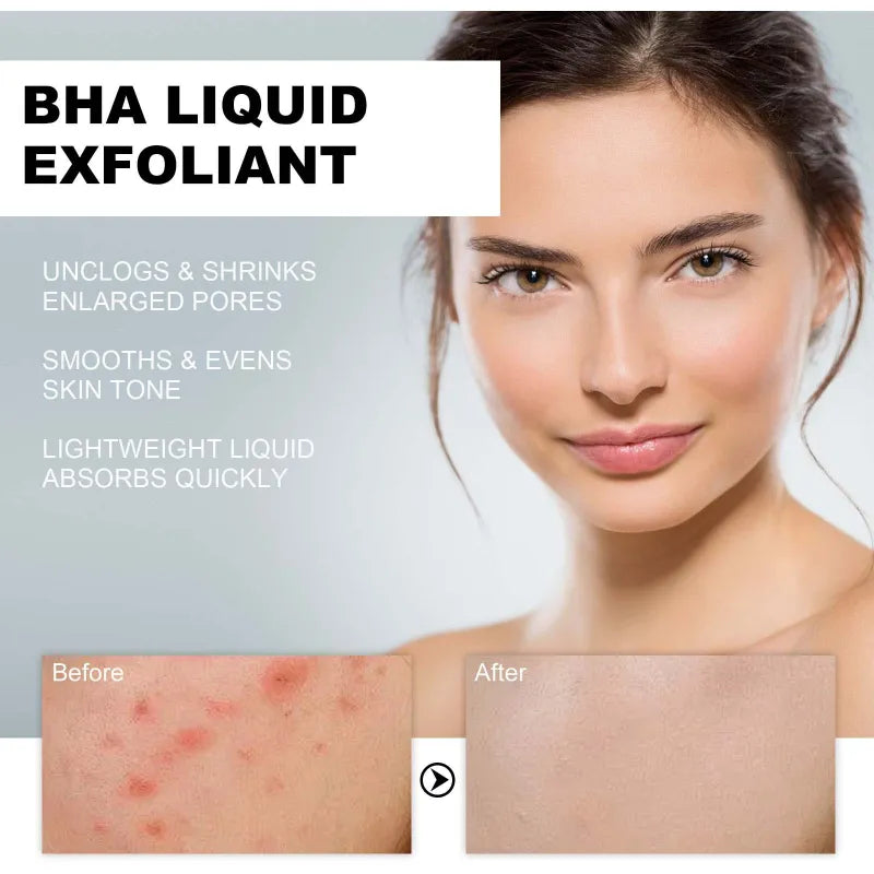 BHA Liquid Exfoliant Acne Treatment Essence