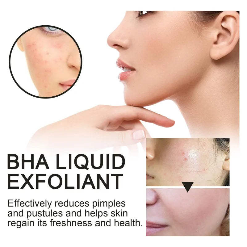 BHA Liquid Exfoliant Acne Treatment Essence